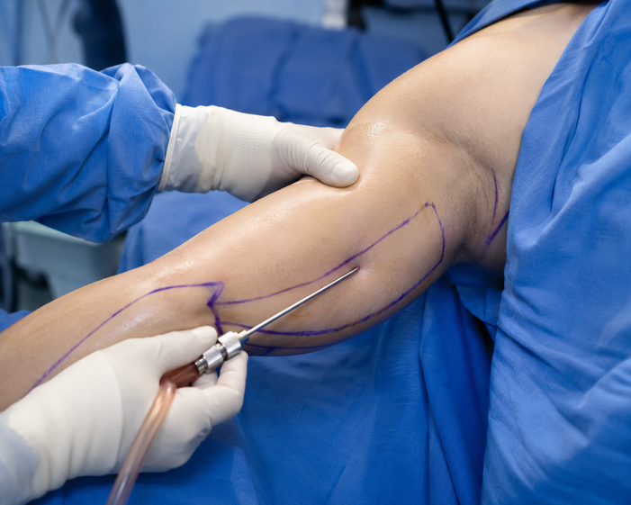 Surgeon consulting a patient about Arm Liposuction
